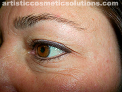 Permanent Eyeliner (Medium, Upper and Lower Eyelids)