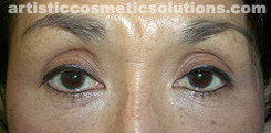 Permanent Eyeliner (Medium, Upper and Lower Eyelids)