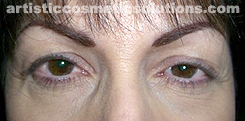 Permanent Eyeliner (Medium, Upper and Lower Eyelids)