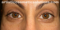 Permanent Eyeliner (Medium, Upper and Lower Eyelids)