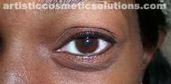 Permanent Eyeliner (Medium, Upper and Lower Eyelids)