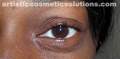 Permanent Eyeliner (Medium, Upper and Lower Eyelids)