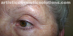 Permanent Eyeliner (Medium, Upper and Lower Eyelids)