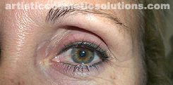 Permanent Eyeliner (Medium, Upper and Lower Eyelids)