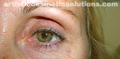 Permanent Eyeliner (Medium, Upper and Lower Eyelids)