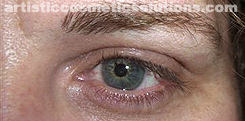 Permanent Eyeliner (Medium, Upper and Lower Eyelids)
