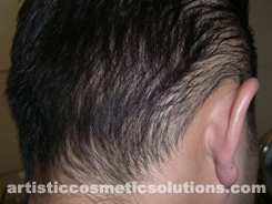 microdermal pigmentation