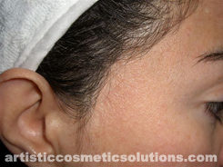microdermal pigmentation