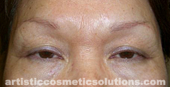 Permanent Eyeliner (Medium, Upper and Lower Eyelids)
