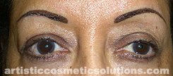 micropigmentation