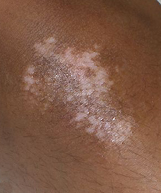 skin camouflage