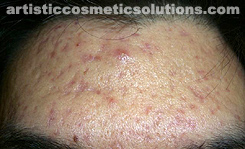 scar treatments