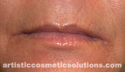 wrinkle treatment