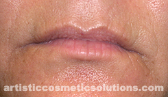 wrinkle treatments