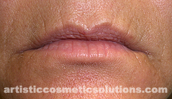 Wrinkle reduction